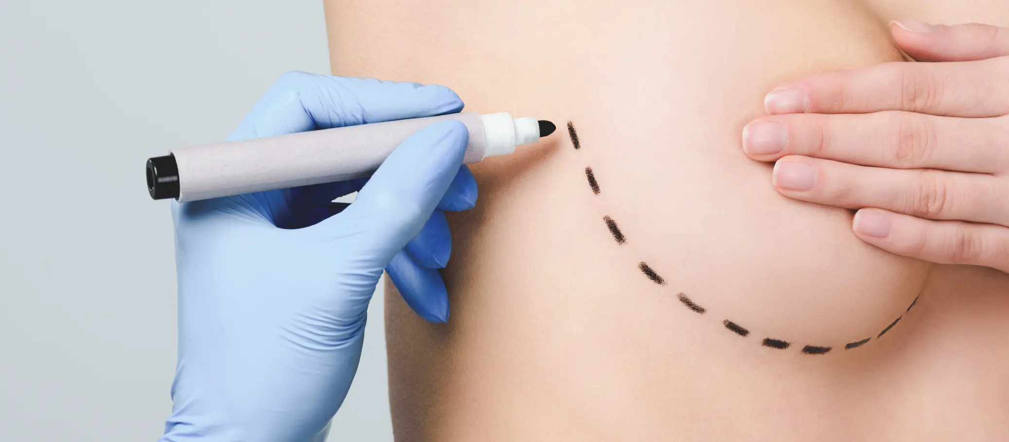 A person in a blue glove is holding a black marker, drawing a dashed line on the skin of a bare torso.