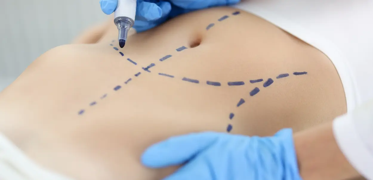 A person wearing blue gloves drawing dashed lines on a bare abdomen with a marker, indicating a planned procedure.