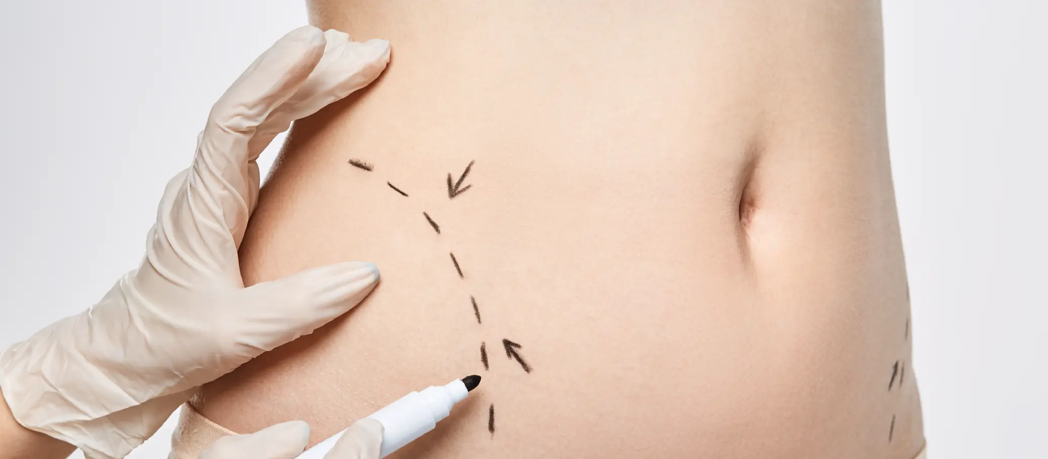 A close-up image of a gloved hand using a black marker to draw dashed lines and arrows on a bare abdomen.