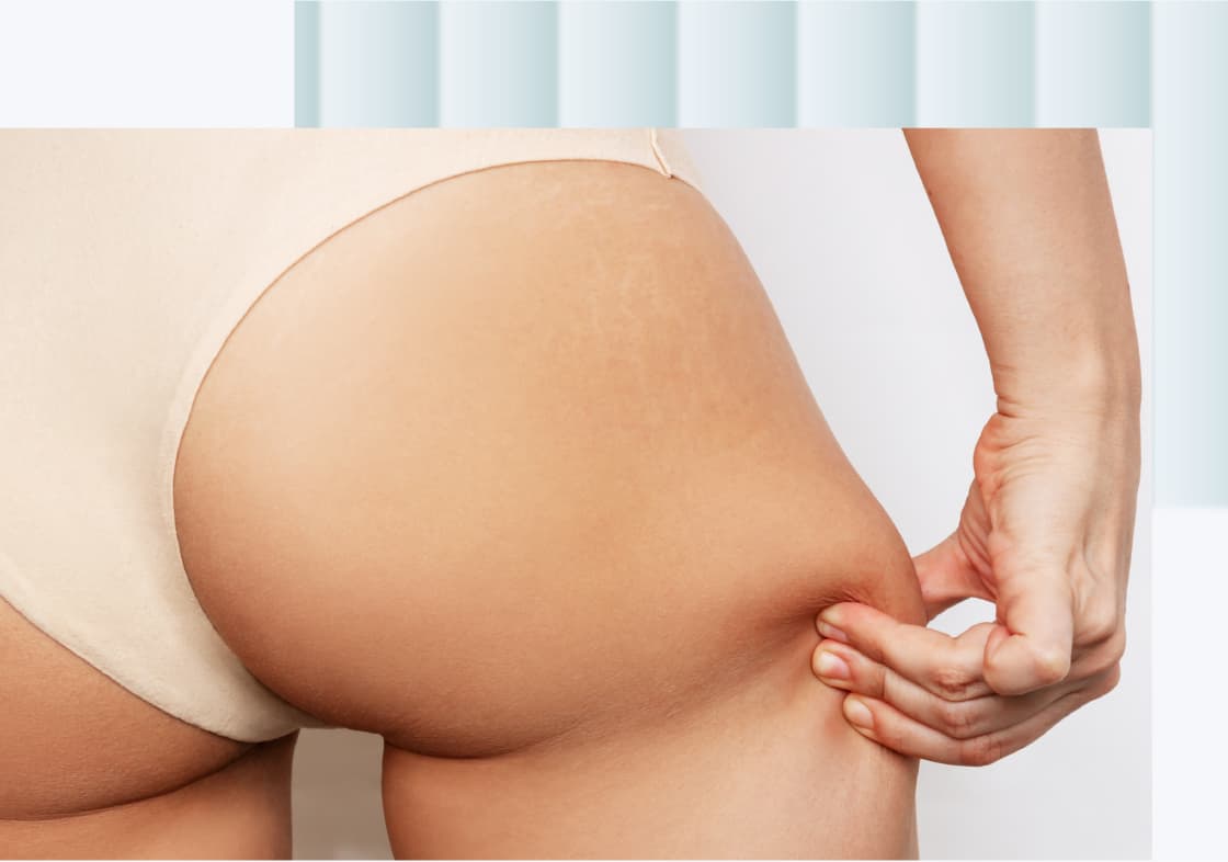 A close-up image of a person's thigh and buttocks, with a hand grasping the skin to show texture, including visible stretch marks on the skin.