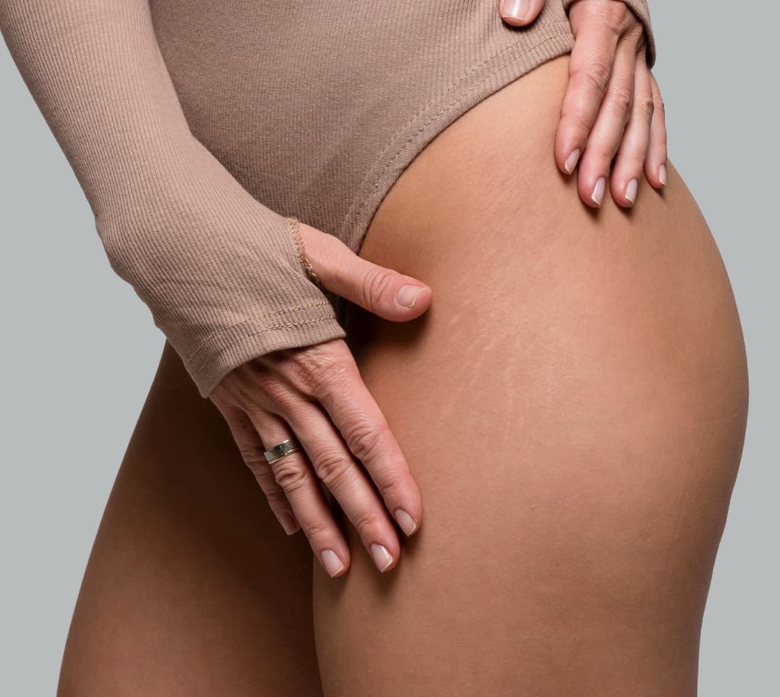 A close-up of a person's thigh with visible skin texture and stretch marks, accompanied by a hand gently touching the thigh. The person is wearing a fitted beige long-sleeve top.