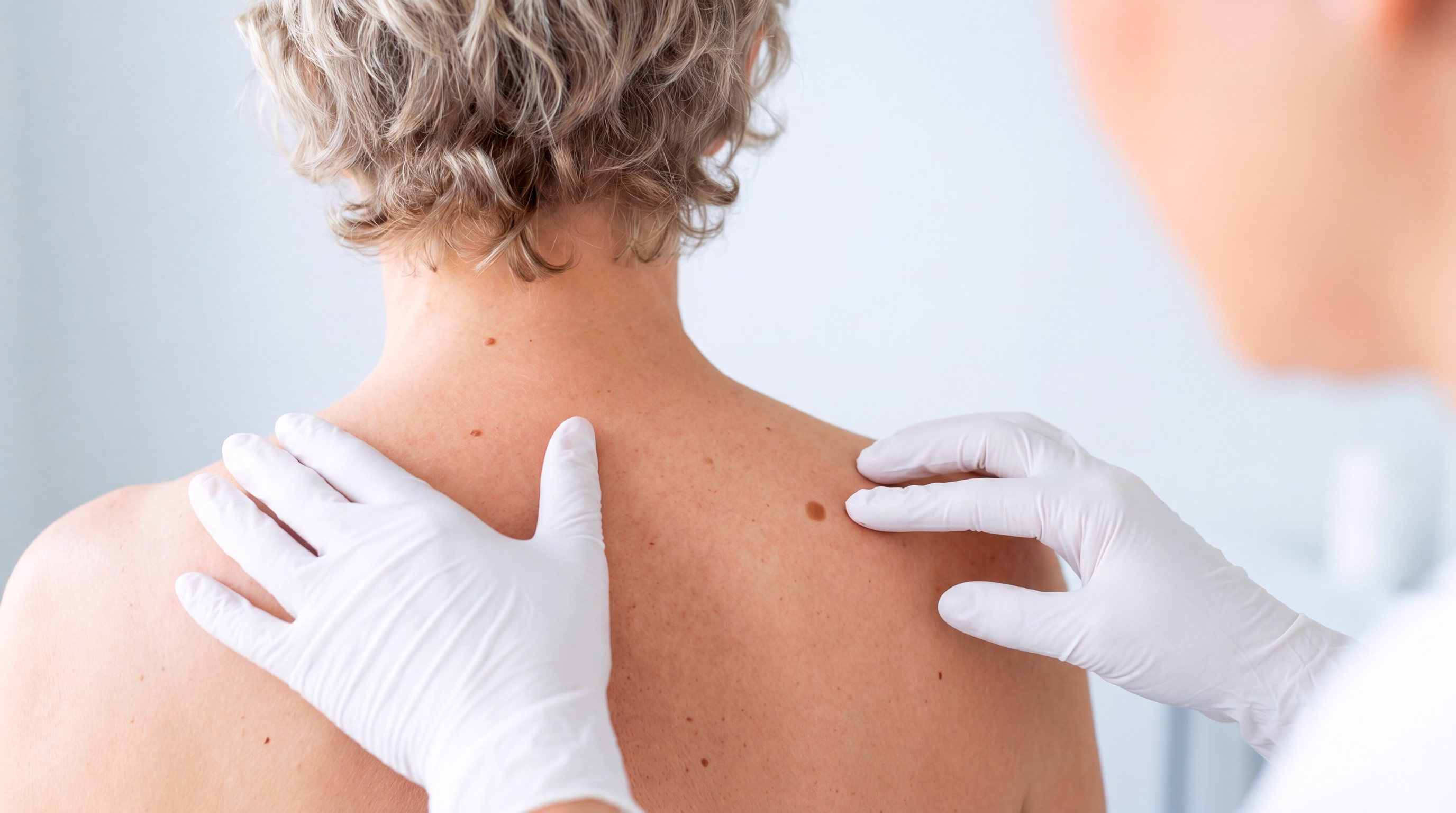 A close-up of a healthcare professional's gloved hands examining the skin on the back of a person with short, curly hair.