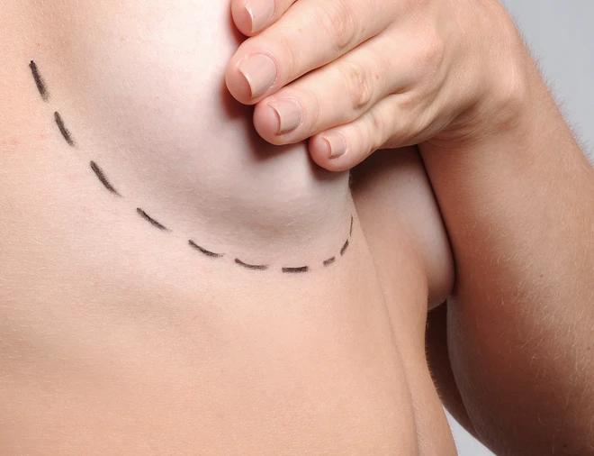 A person's hand gently pressing against a bare torso, with a dashed line marked along the side of the body, indicating a possible measurement or contour for cosmetic purposes.