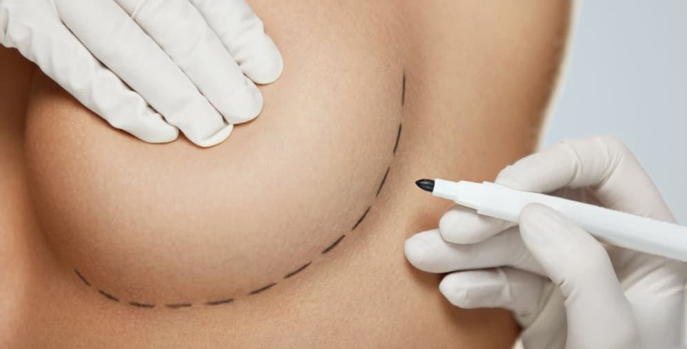 A person's hand wearing a white glove holds a black marker above a breast, marking a curved line for a procedure.