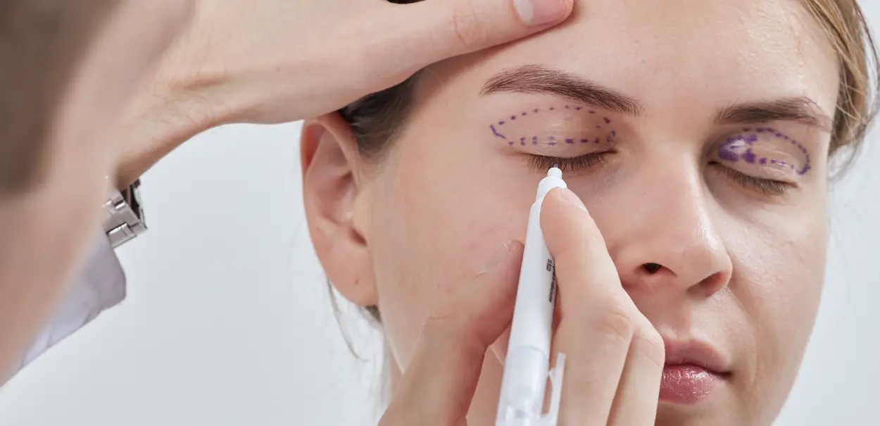 A person using a white pen to mark dotted lines on the eyelids of a woman with closed eyes, indicating a cosmetic procedure.