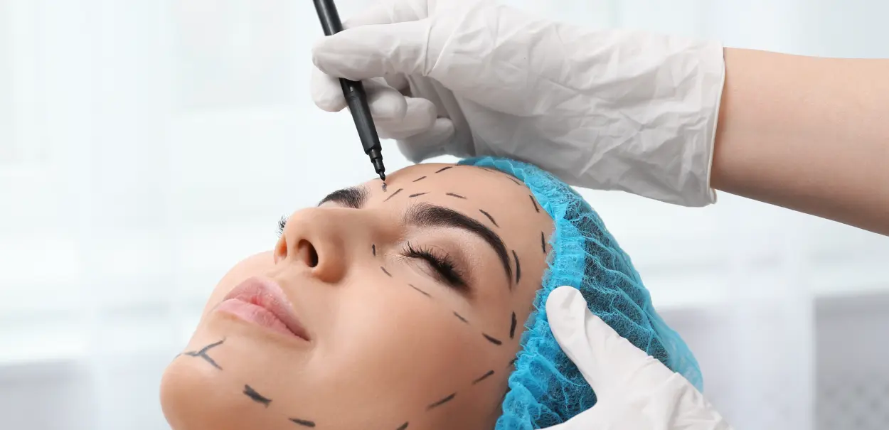 A close-up image of a woman's face being marked with a pen by a person wearing a white glove. The woman is lying down with her eyes closed, and her head is covered with a blue surgical cap. The markings on her face consist of dashed lines indicating.