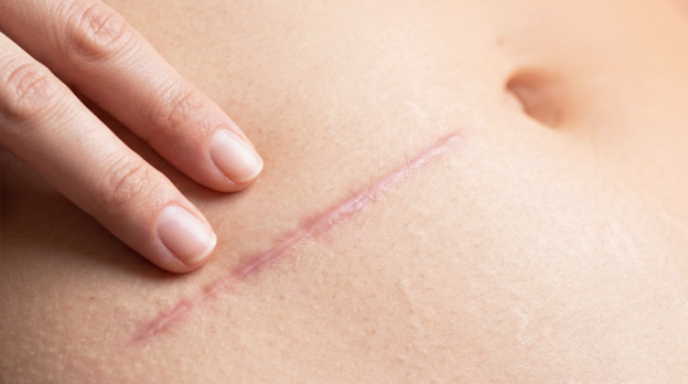 A close-up image of a person's abdomen featuring a healing surgical scar with a hand gently touching it.