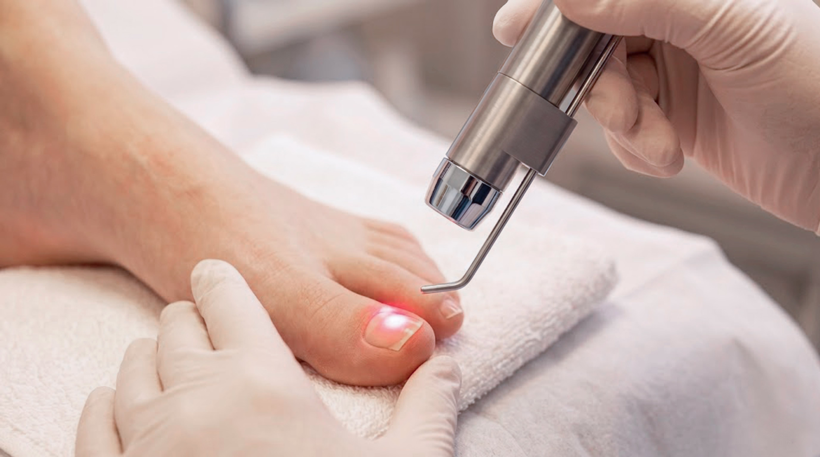 A hand holding a laser device over a person's toenail, with a red light coming from the device, while the foot is resting on a white towel.