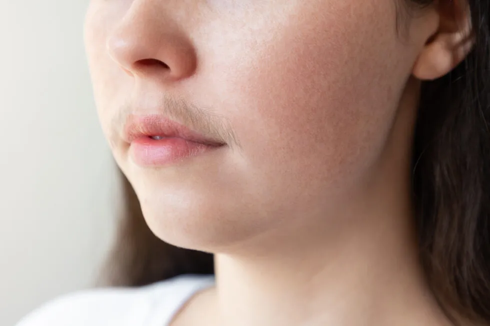 Hirsutismus bei Frauen: Ursachen und Behandlung