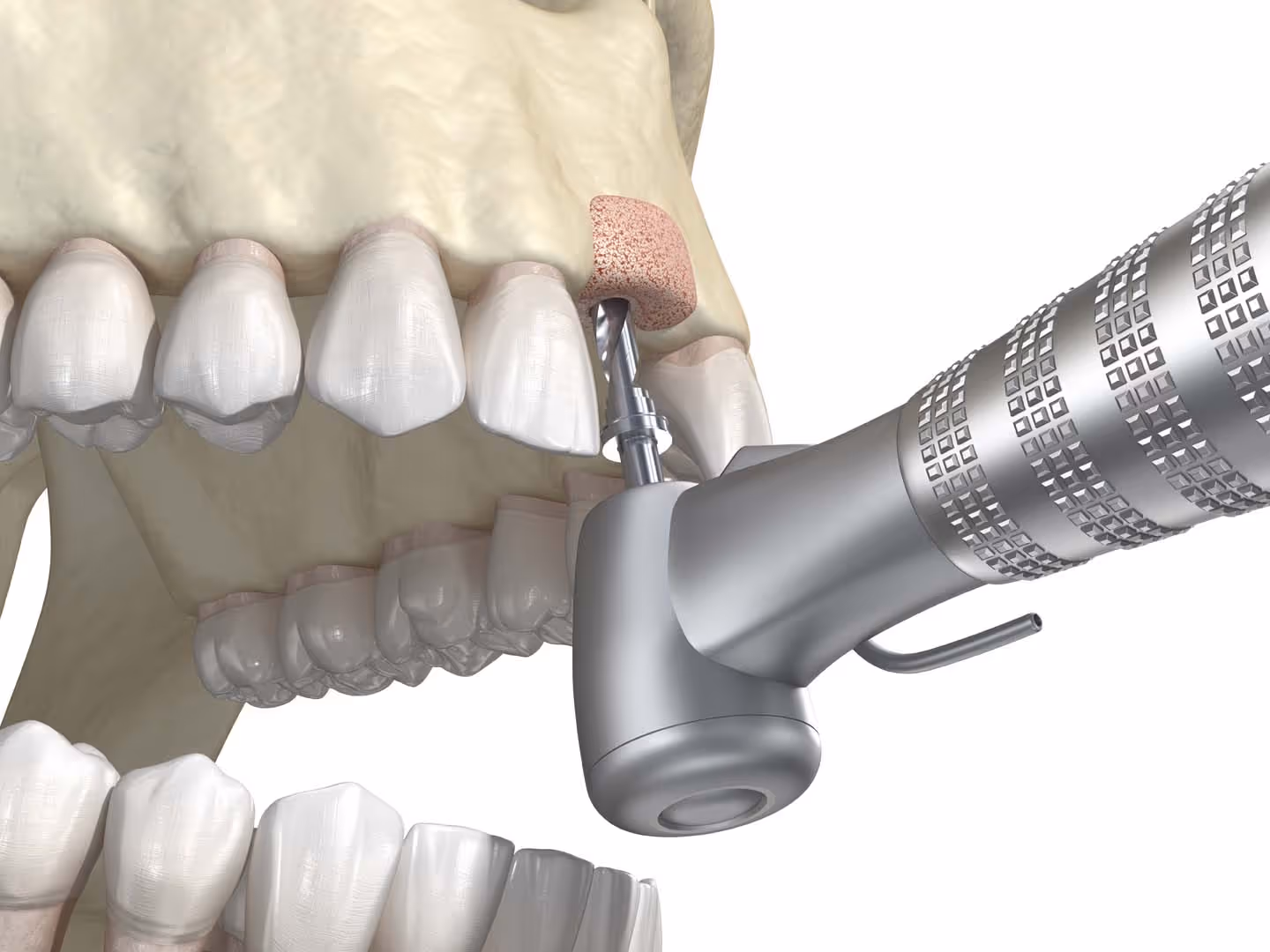 Sinus Lift Surgery in Charleston, SC