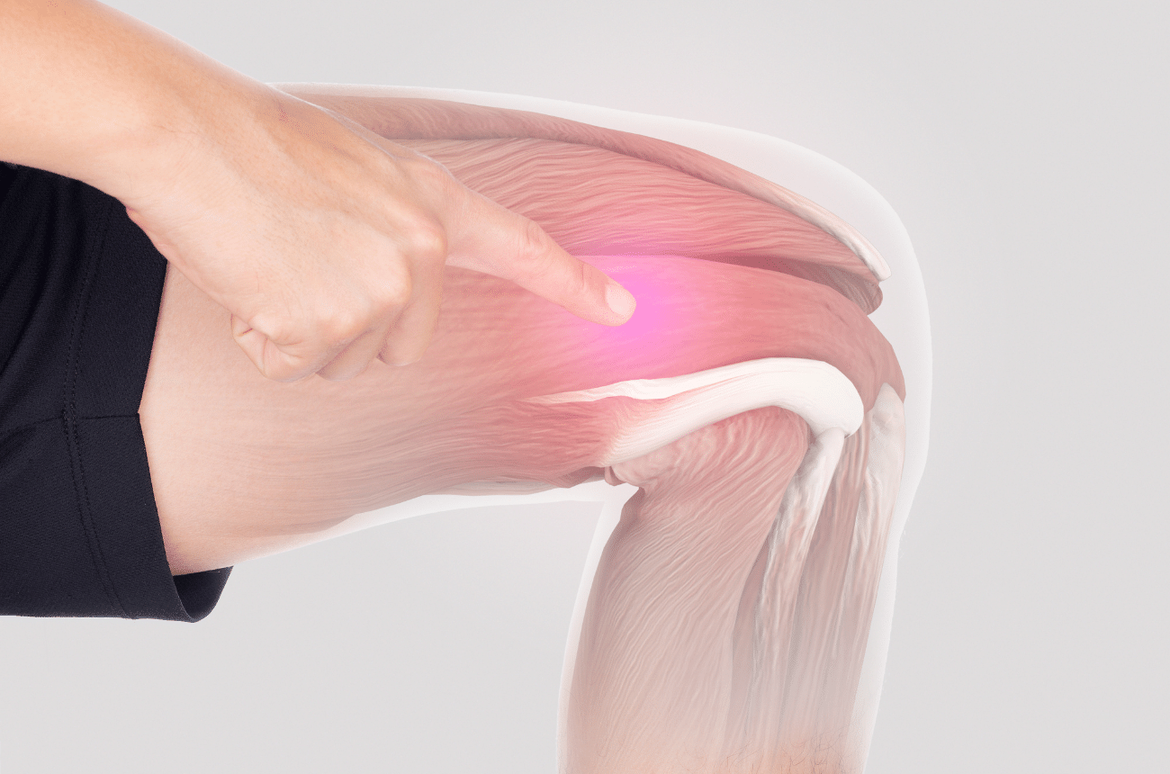 Recovering from total knee replacement surgery can take a bit of work. However, by focusing on improving range of motion and leg strength, you'll be on the path towards resuming your day-to-day activities in no time. Here are the three main muscle groups in the upper leg that will require your attention and rehabilitation to return to normal levels of strength:
