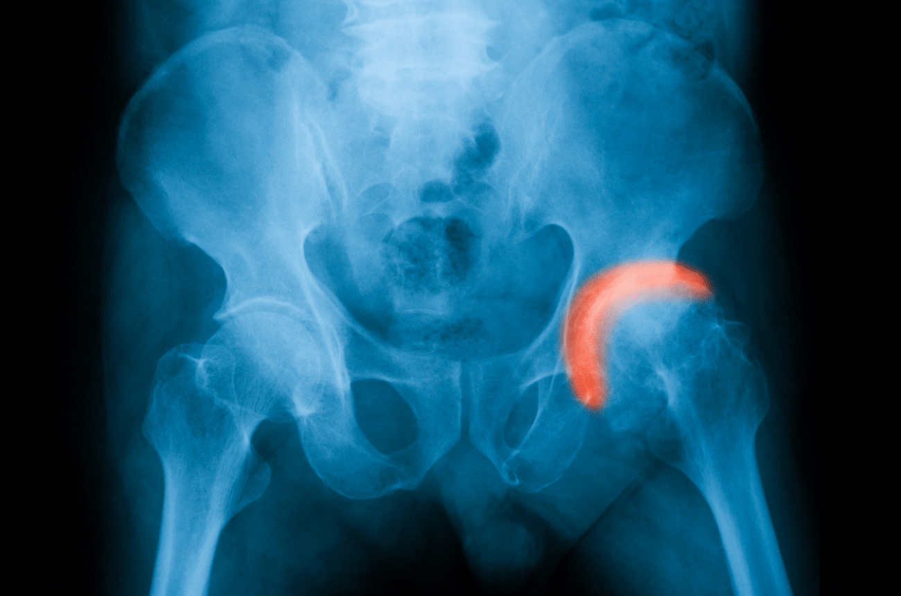 After having a Total Hip Replacement, your doctor might recommend that you avoid certain movements for the first 6-10 weeks of recovery. These restrictions are given as precautions in order to prevent dislocation of the new joint. Examples of movements or exercises to avoid are...