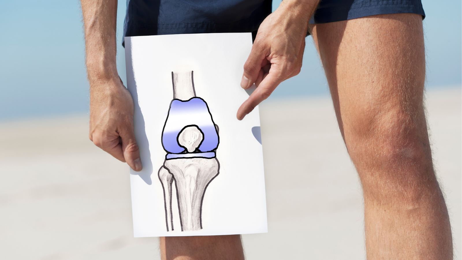 A knee replacement refers to a surgical procedure in which part or all of the knee is removed and replaced with a prosthetic knee joint. When referring to a knee replacement, there are two main types: