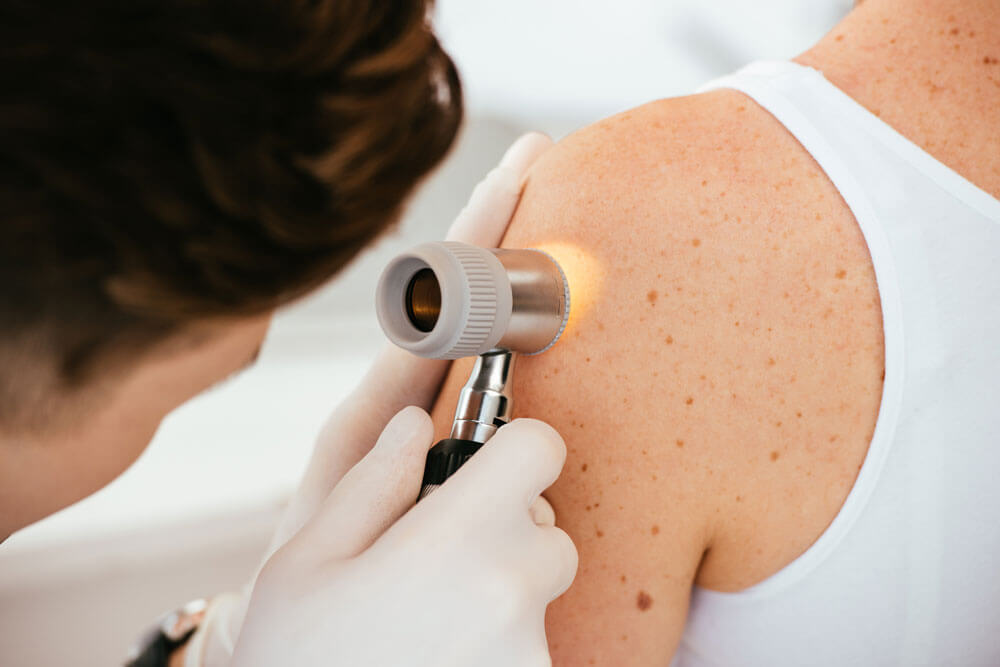 IPL photofacial treatment
