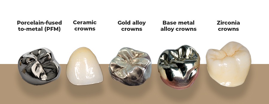 Dental Crowns: Types, Costs and Benefits - Parla Clinics