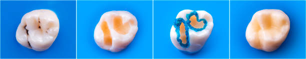 tooth restoratin by esthetic composite filling befor e and after picture tooth restoratin by esthetic composite filling befor e and after picture Before/after concept—left: a cracked cusp highlighted; right: photo of a natural-looking ceramic crown seated stock pictures, royalty-free photos & images