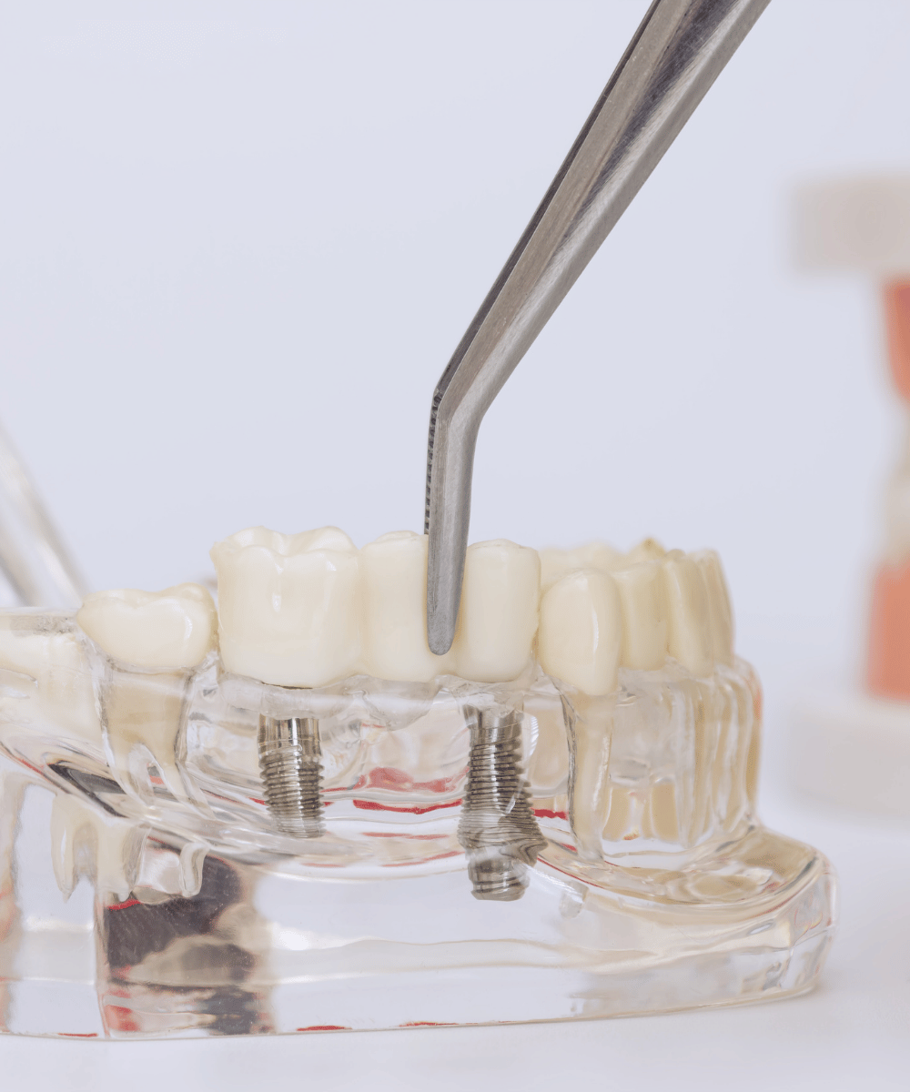 Close-up of a dental bridge supported by two dental implants on a demonstration model.