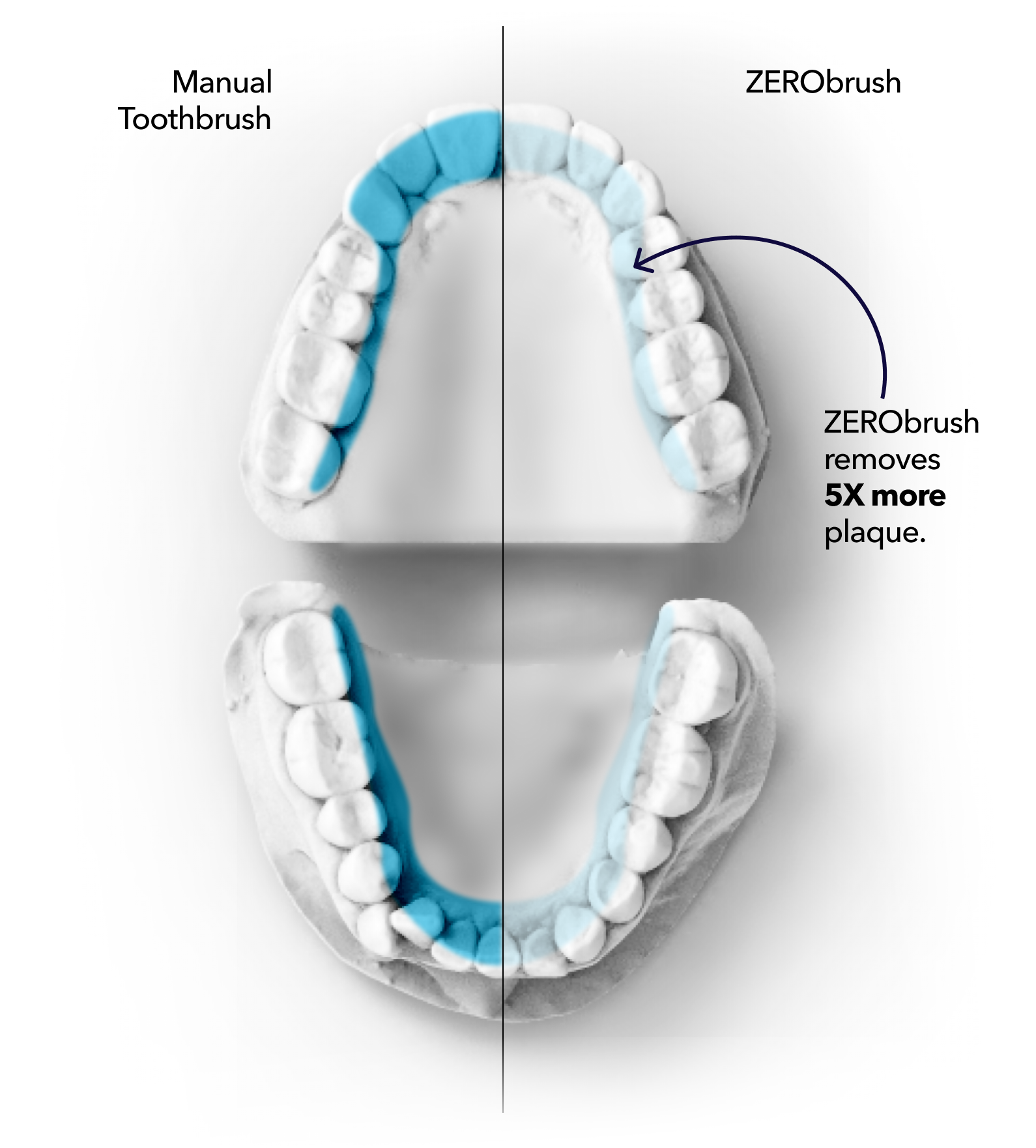 Comparison diagram of a mouth showing the results of the clinical trial. ZERObrush removes 5 times more plaque from the inside surfaces of your mouth than a manual toothbrush in twice the time.