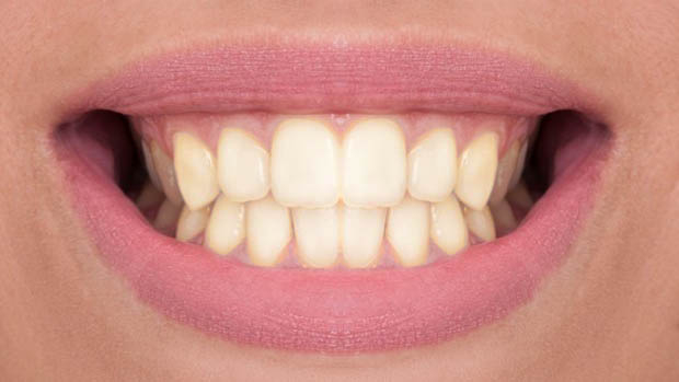 teeth before the whitening treatment