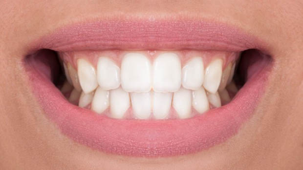 teeth after the whitening treatment