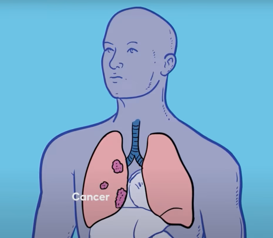 Illustration of a human upper body with lungs shown; the left lung has three cancerous tumors highlighted.