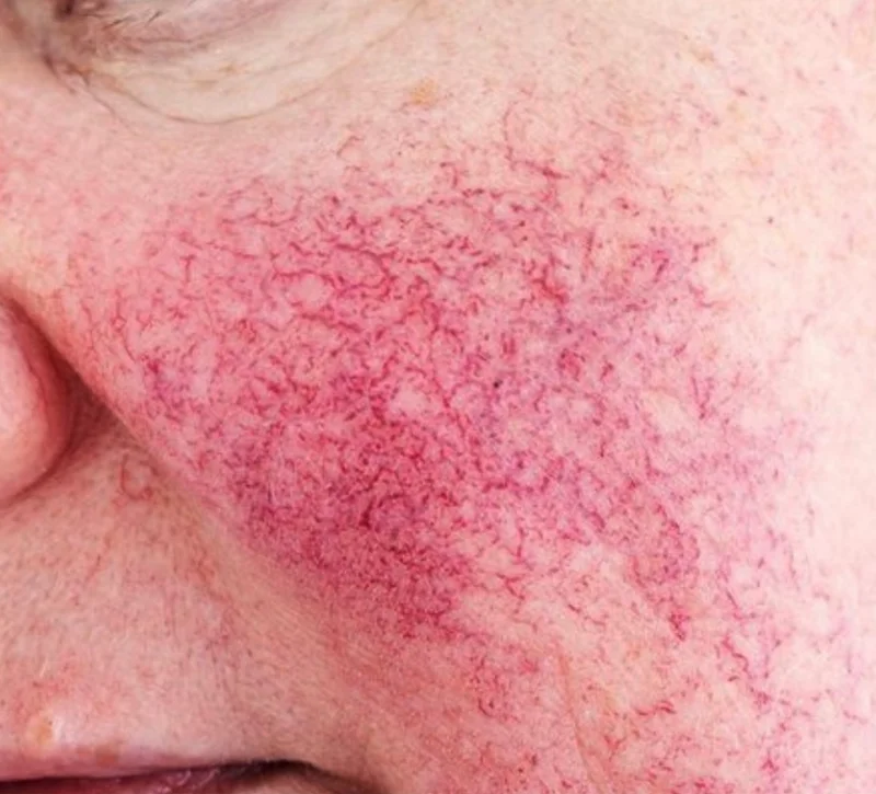 Rosacea-Safe Facials in McKinney: Treatments for Sensitive, Reactive Skin