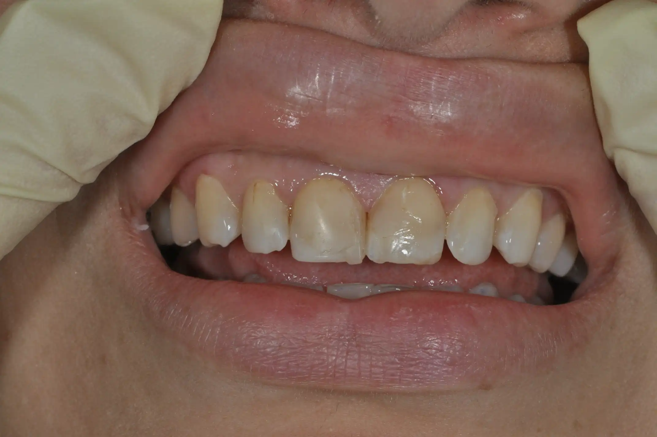 Close-up of a person's upper front teeth showing discoloration, wear, and some chipping.