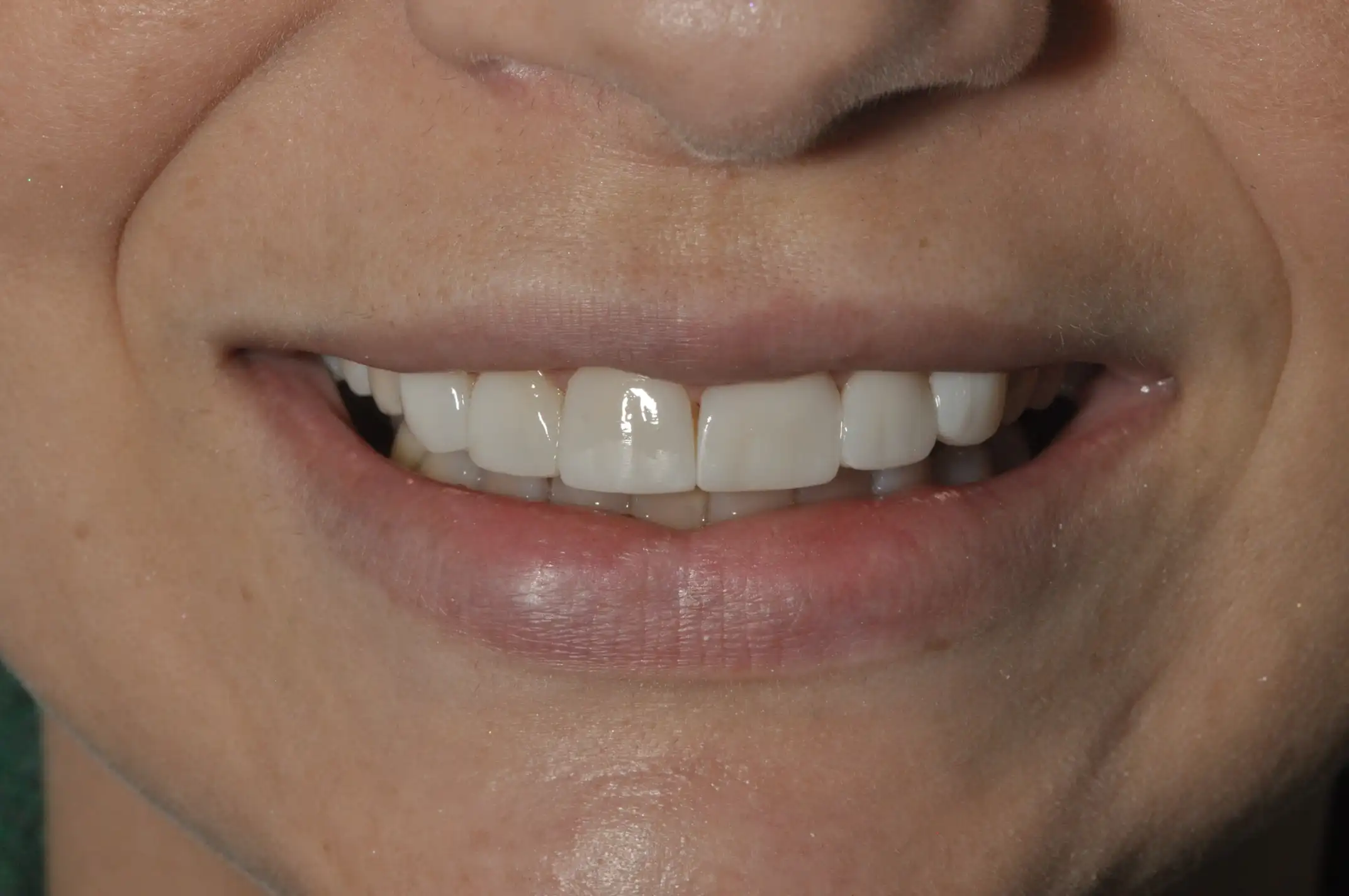Close-up of a smiling mouth showing clean, white, and straight upper teeth.