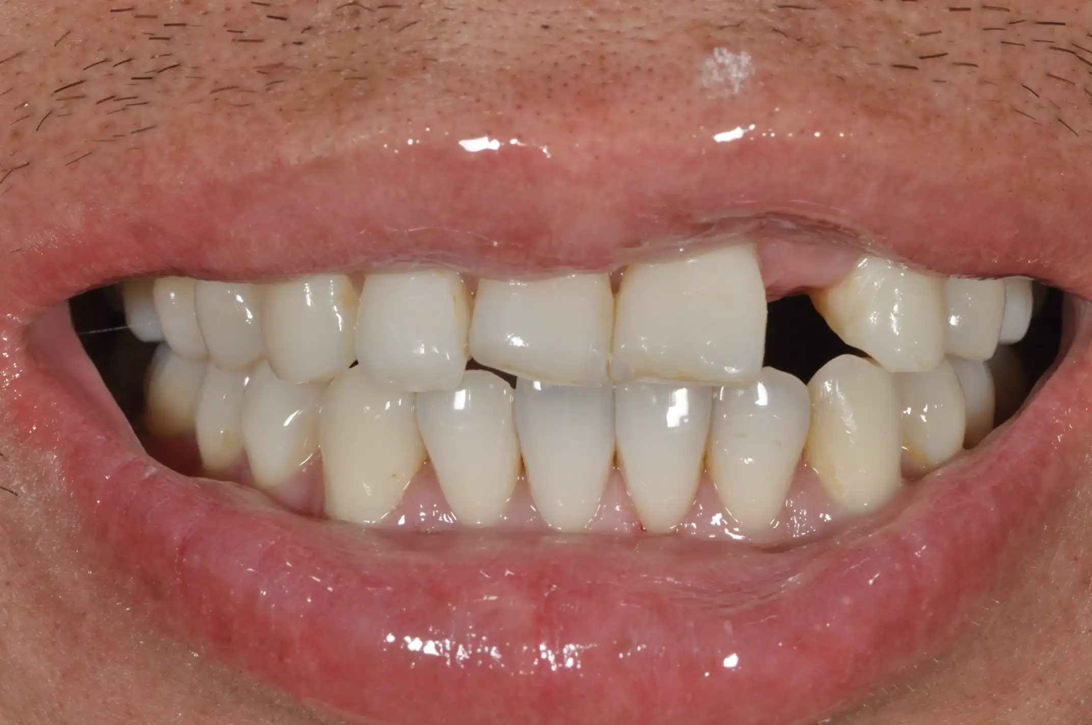 Close-up of a person's mouth showing upper teeth with a missing front tooth and some yellow discoloration.