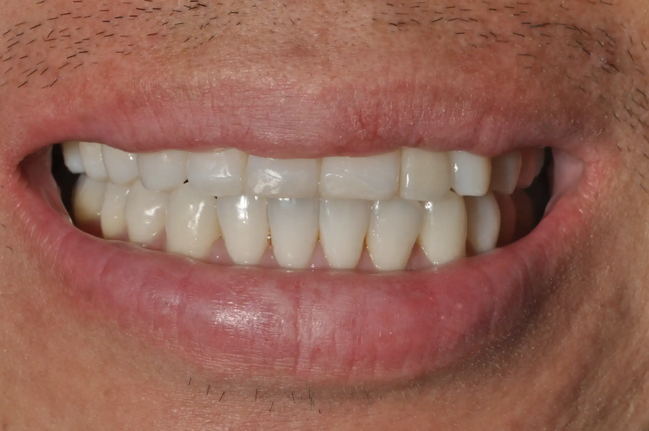 Close-up of a person's mouth smiling, showing clean, well-aligned white teeth.