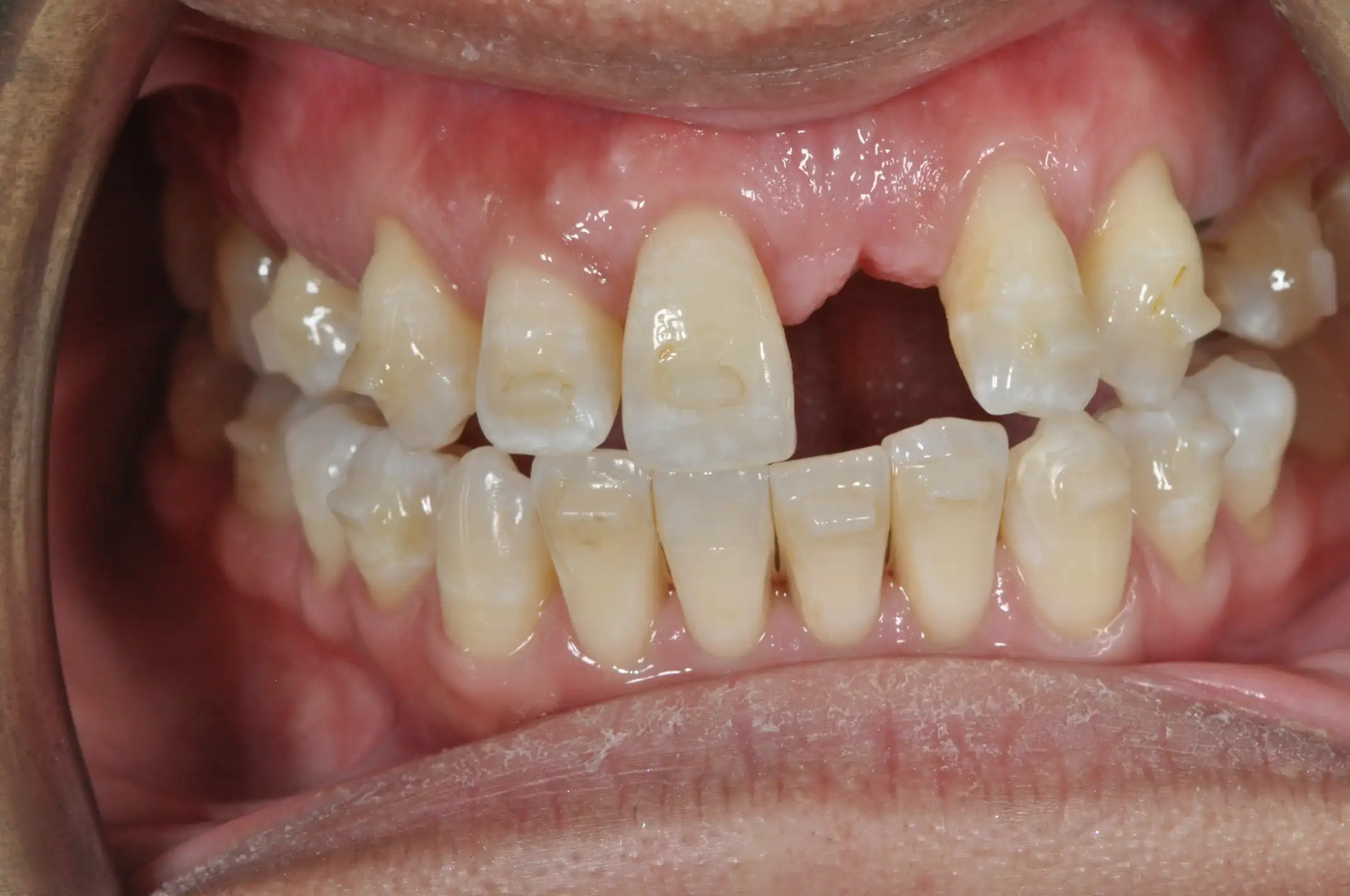 Close-up of a patient's upper and lower teeth showing a missing front tooth and mild dental crowding.