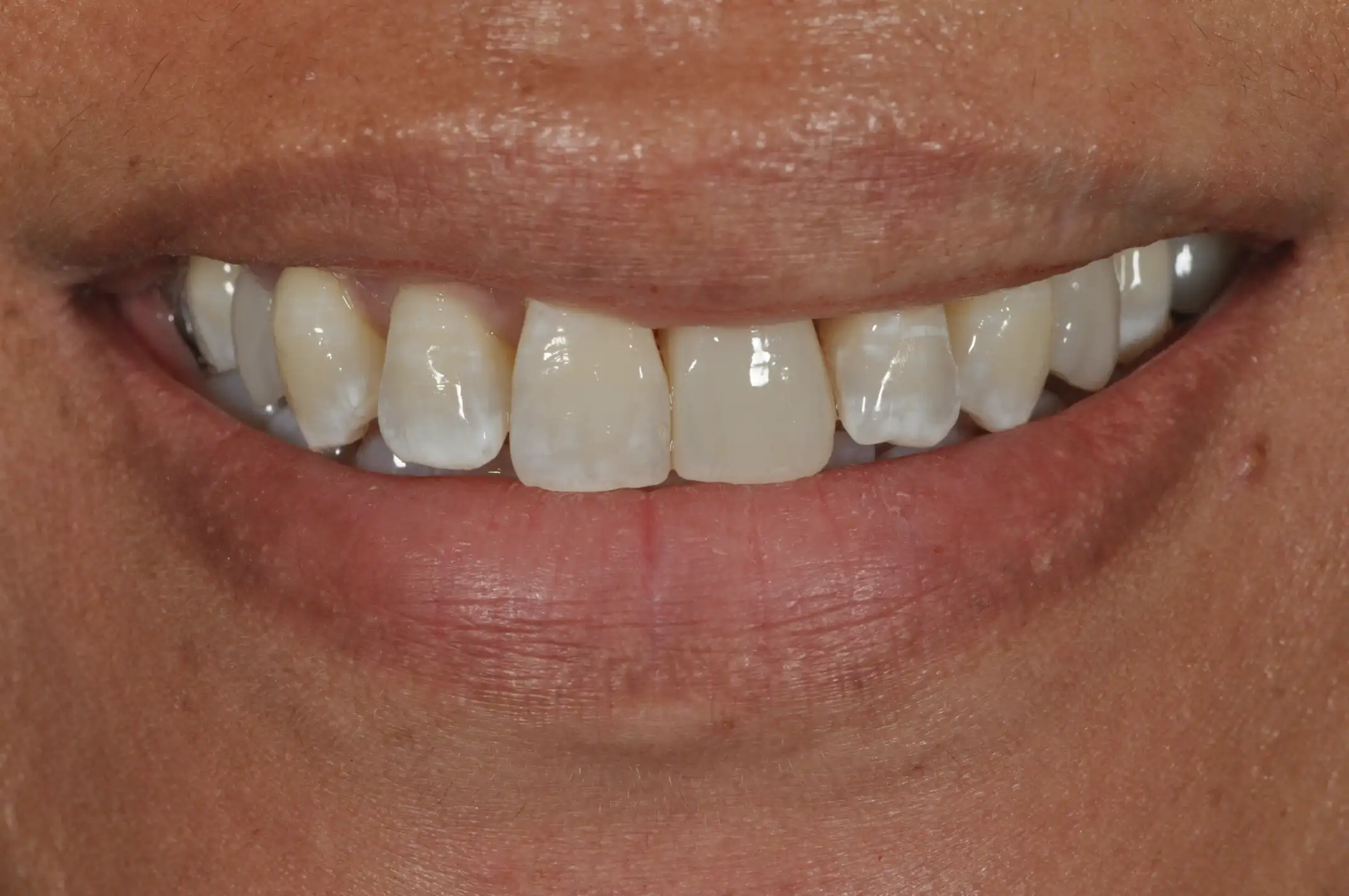 Close-up of a smiling person's mouth showing teeth with some white spots and slight discoloration.