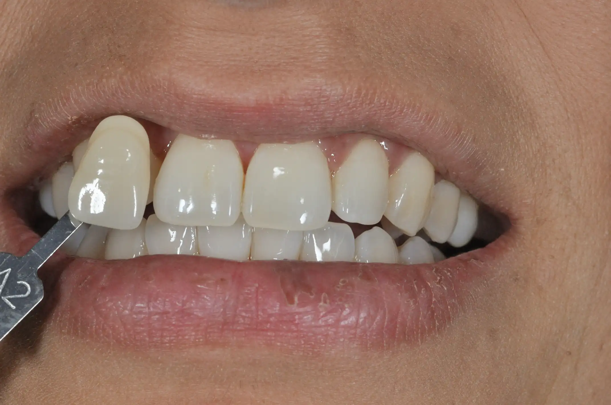 Close-up of a person's smile with a dental shade guide held against the front teeth for color matching.