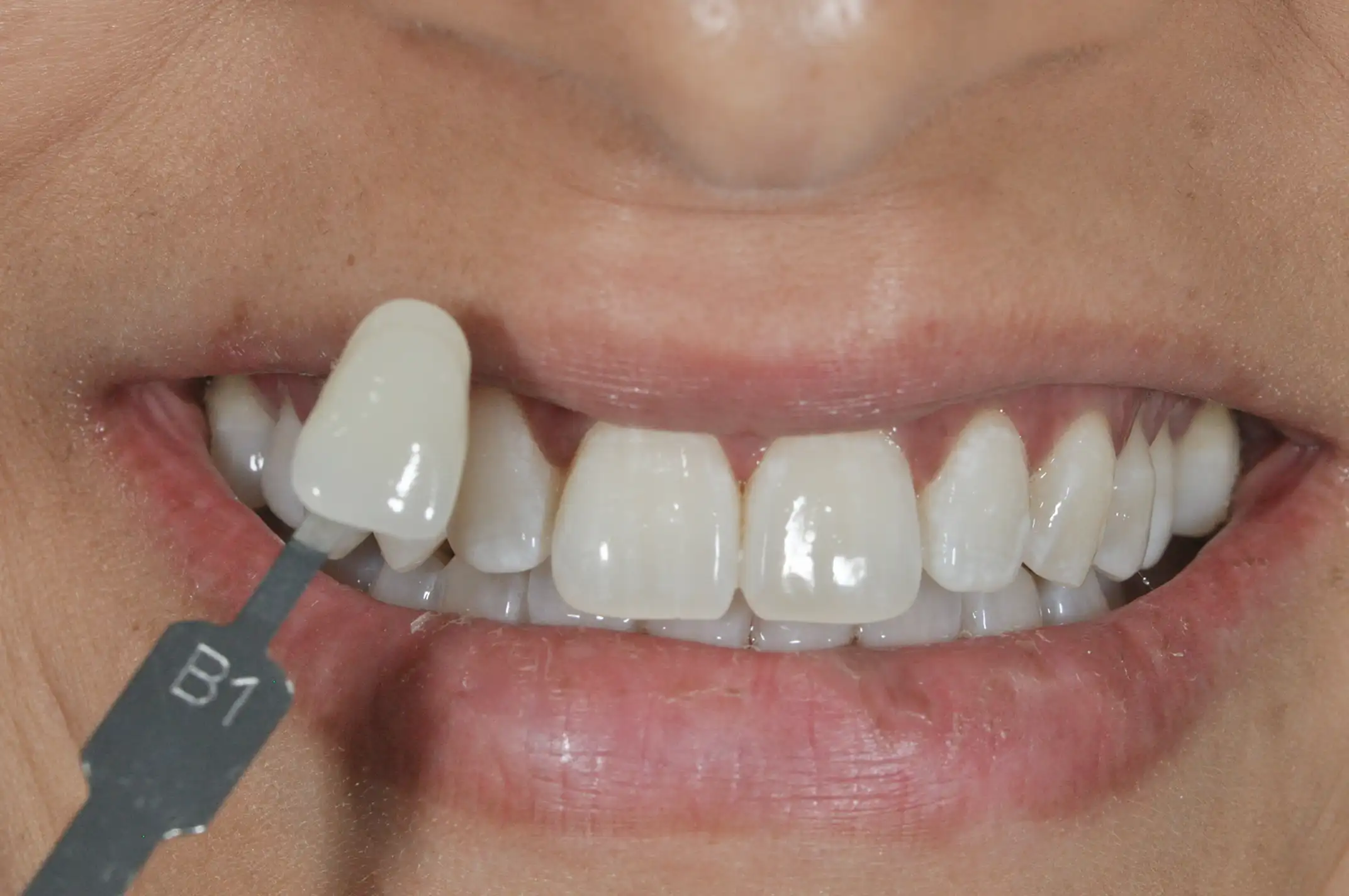 Close-up of a smiling mouth showing teeth with a dental shade guide marked B1 held next to the front teeth for color matching.