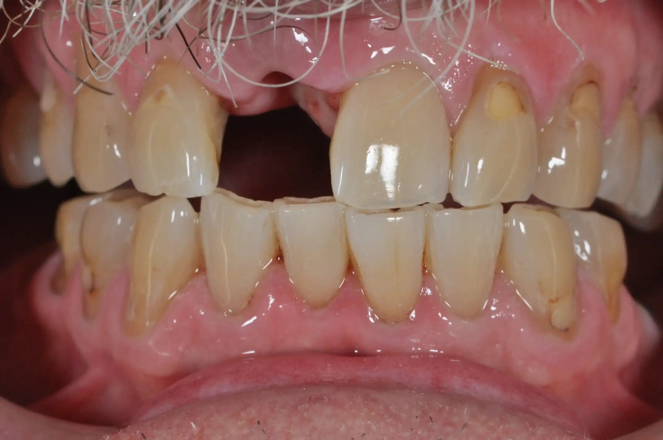 Close-up of upper and lower front teeth with missing upper left central incisor and visible staining on several teeth.