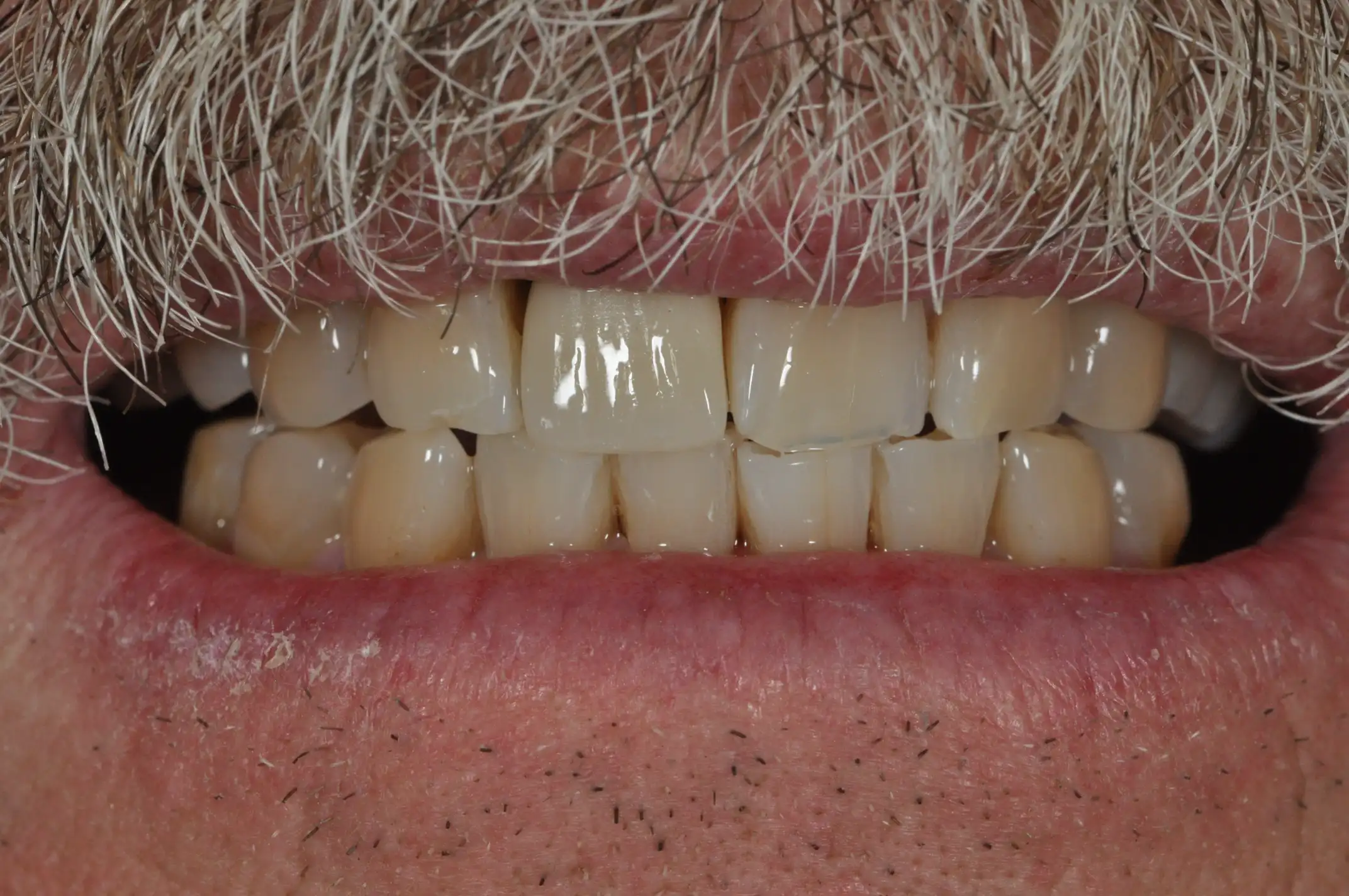 Close-up of an elderly man's mouth showing upper and lower teeth with a mustache above the lip.