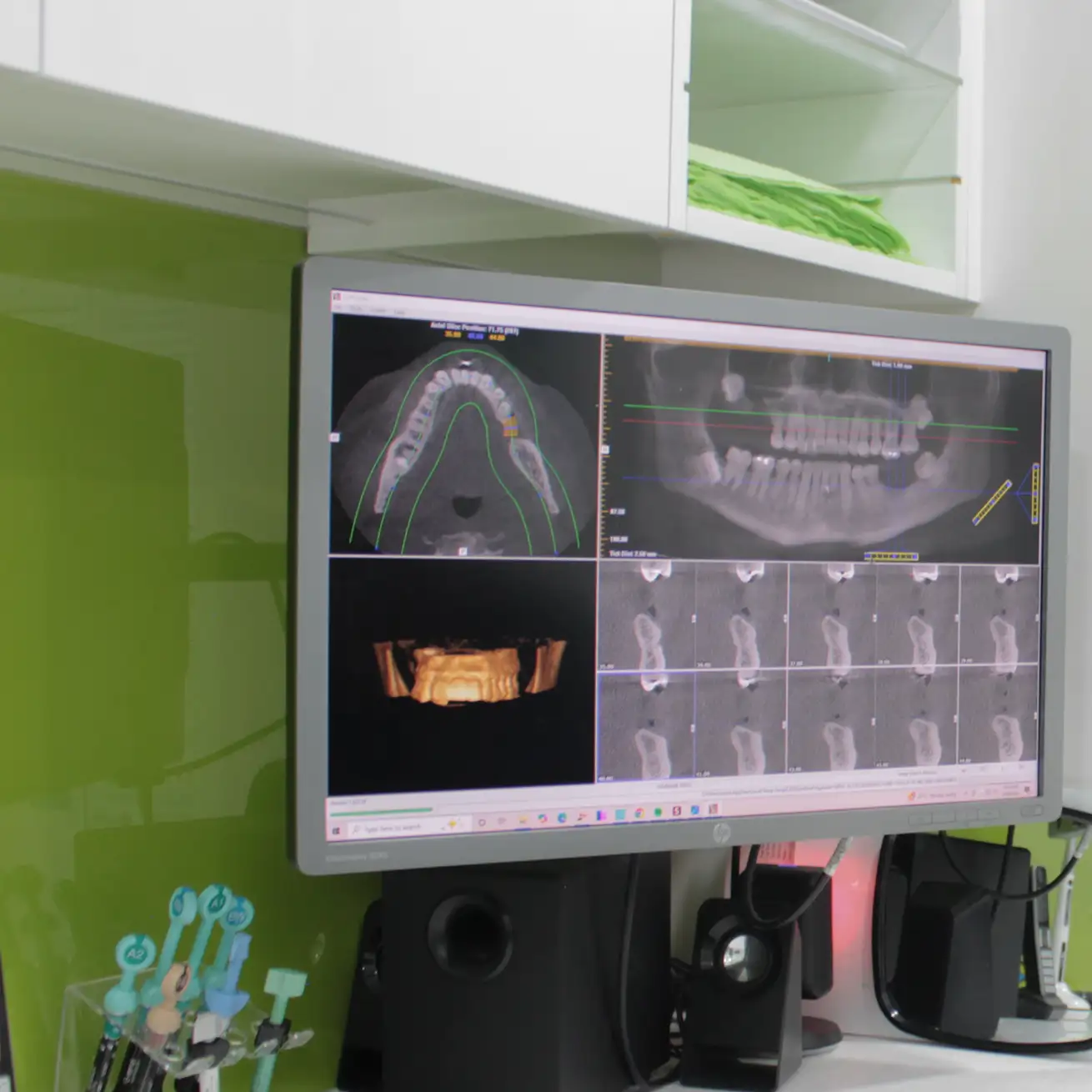 Computer screen displaying dental X-ray scans and 3D dental imaging in a clinic setting.