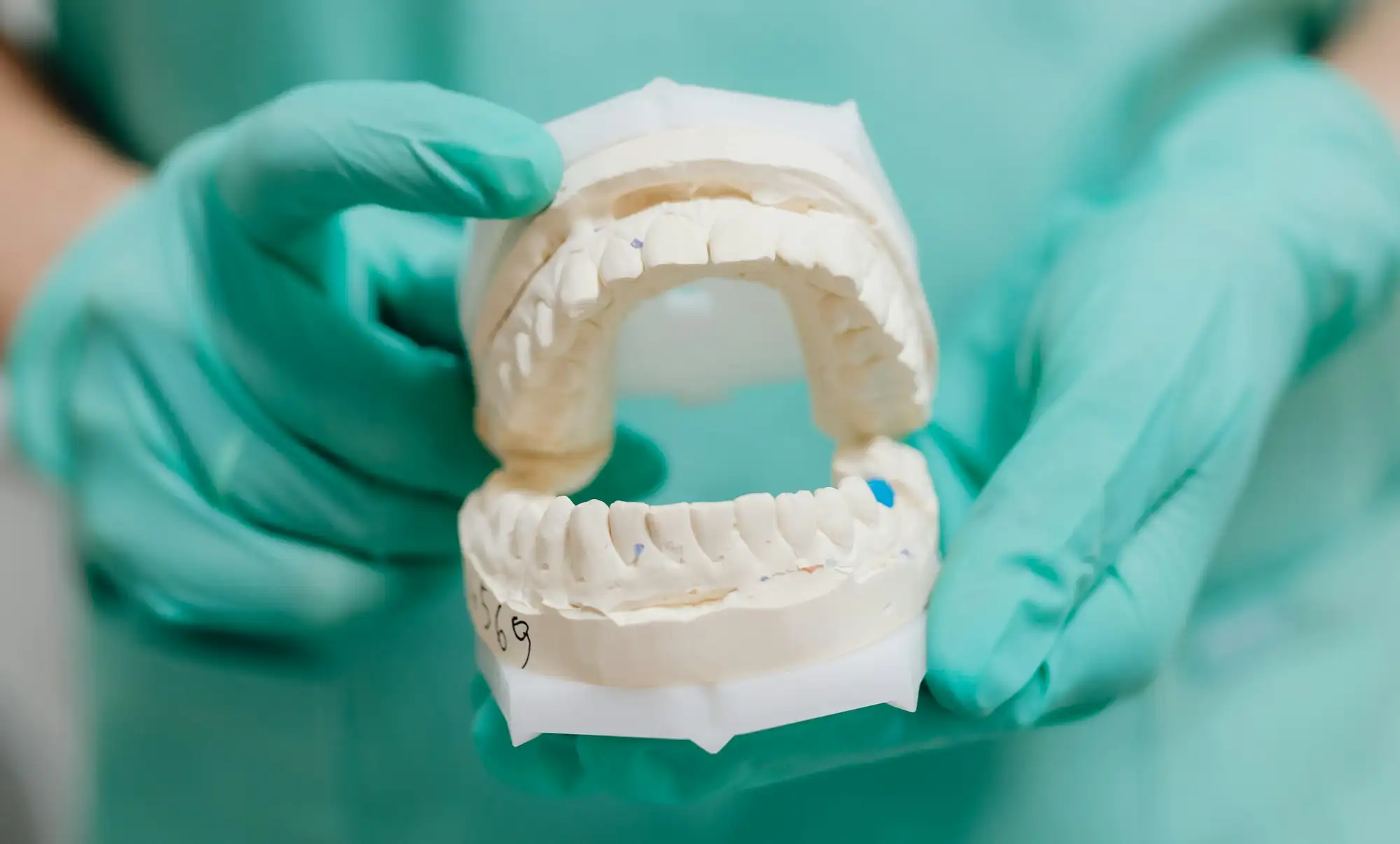 Close-up of hands in green gloves holding a dental mold of upper and lower teeth.