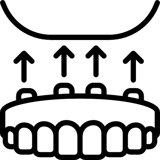 Illustration of a dental implant supported denture with upward arrows indicating support or attachment.