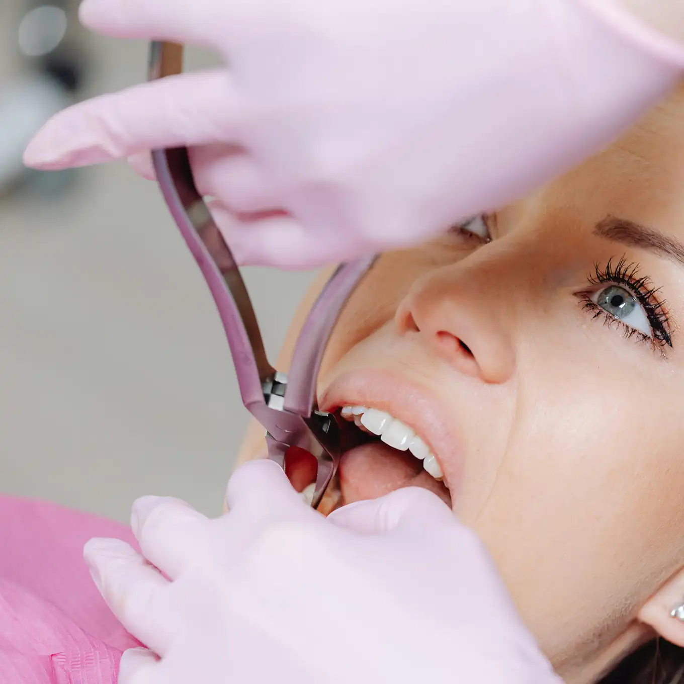 Close-up of dentist wearing pink gloves extracting a tooth from a patient's mouth using dental forceps.
