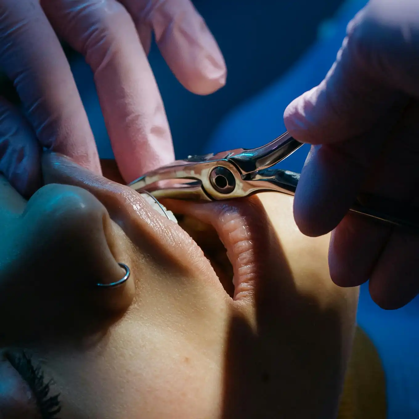 Close-up of a dental professional using forceps to extract a tooth from a patient's mouth.