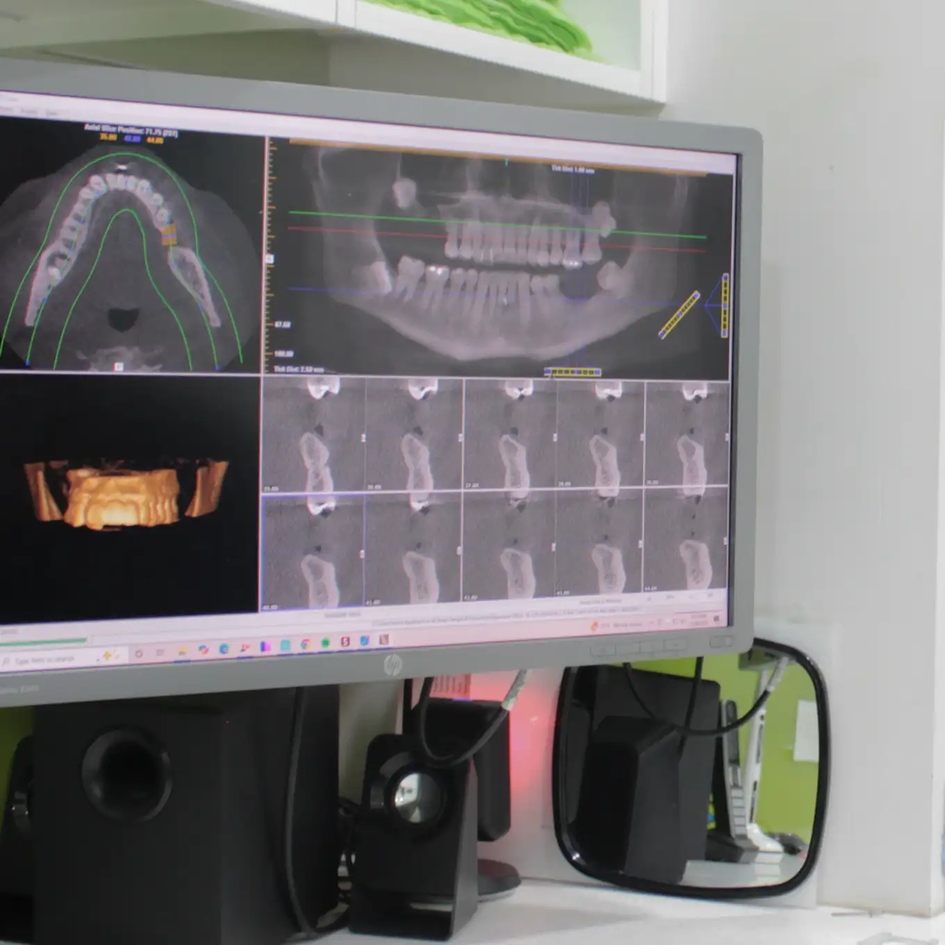 Computer screen displaying various dental X-rays and 3D images of teeth and jaw structure.