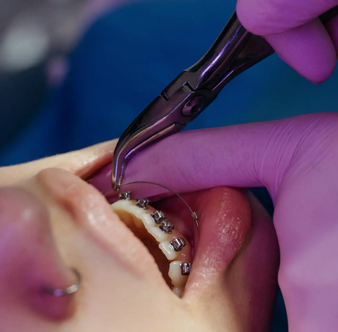 Close-up of a dental professional with purple gloves adjusting metal braces inside a patient's mouth using a dental tool.