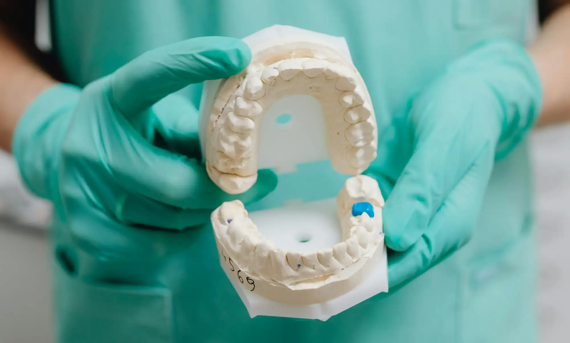 Hands in green gloves holding a dental mold showing upper and lower teeth with a blue marking on one tooth.