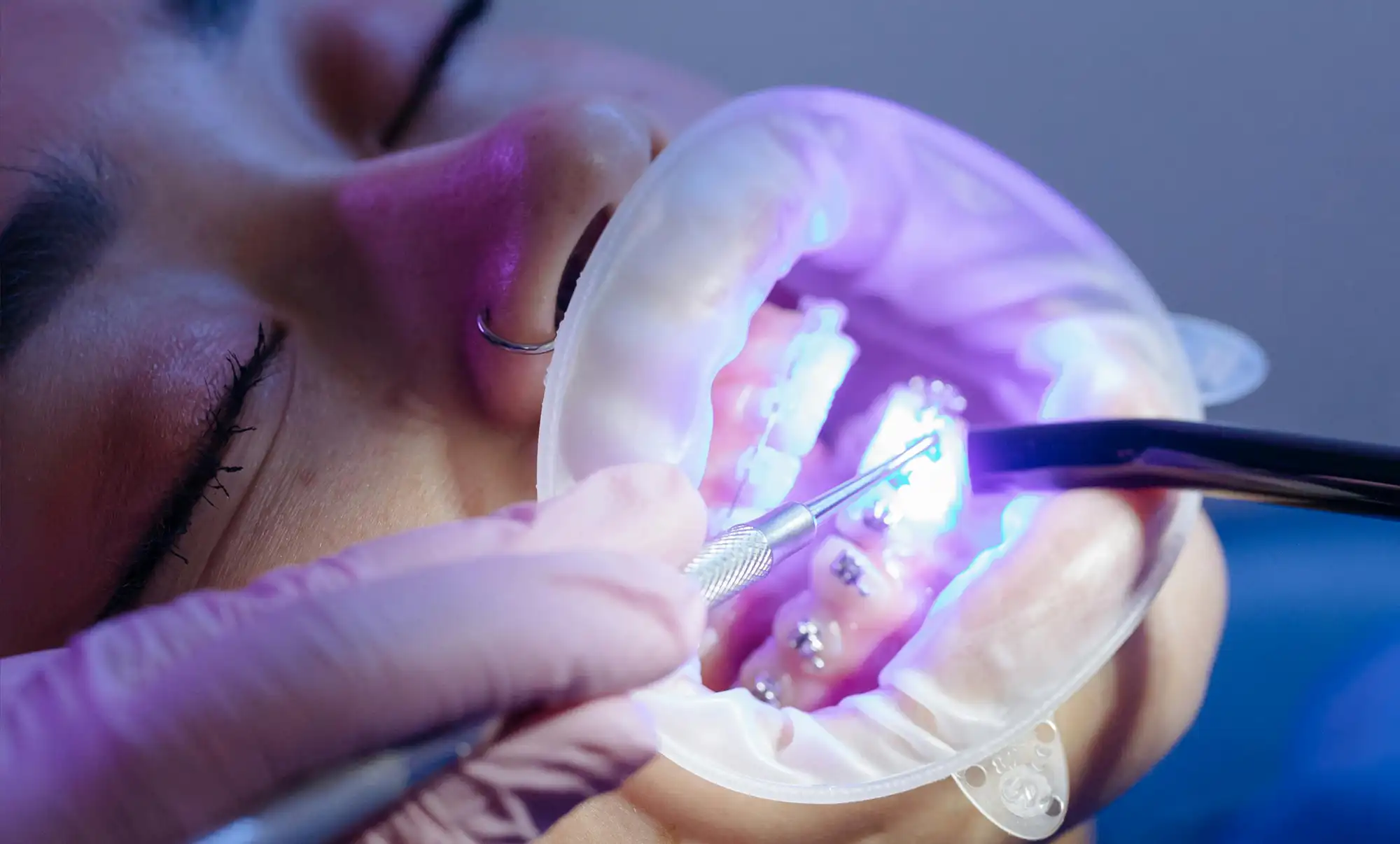 Close-up of dental braces being treated with a curing light and dental tool in a patient's mouth.