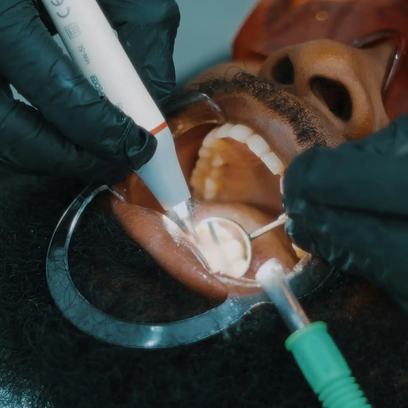 Close-up of dental professional performing a teeth whitening procedure on a patient wearing protective glasses.