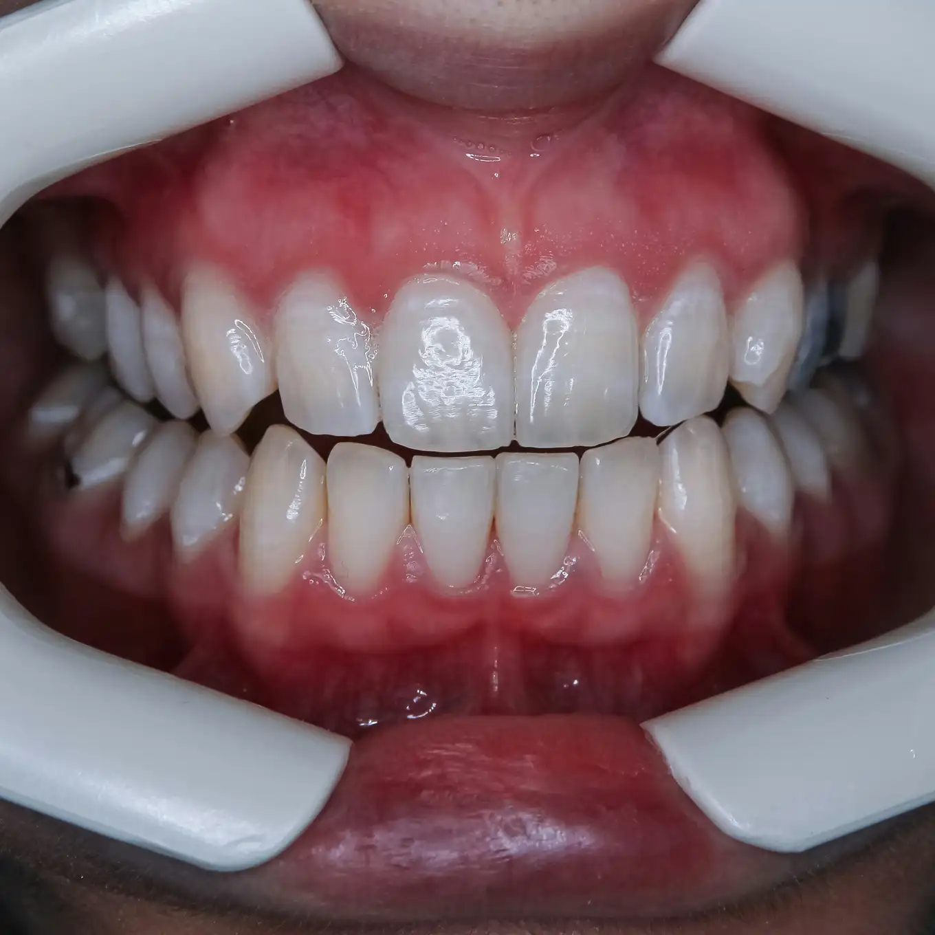 Close-up of upper and lower teeth with a dental cheek retractor exposing healthy gums and teeth after teeth whitening.