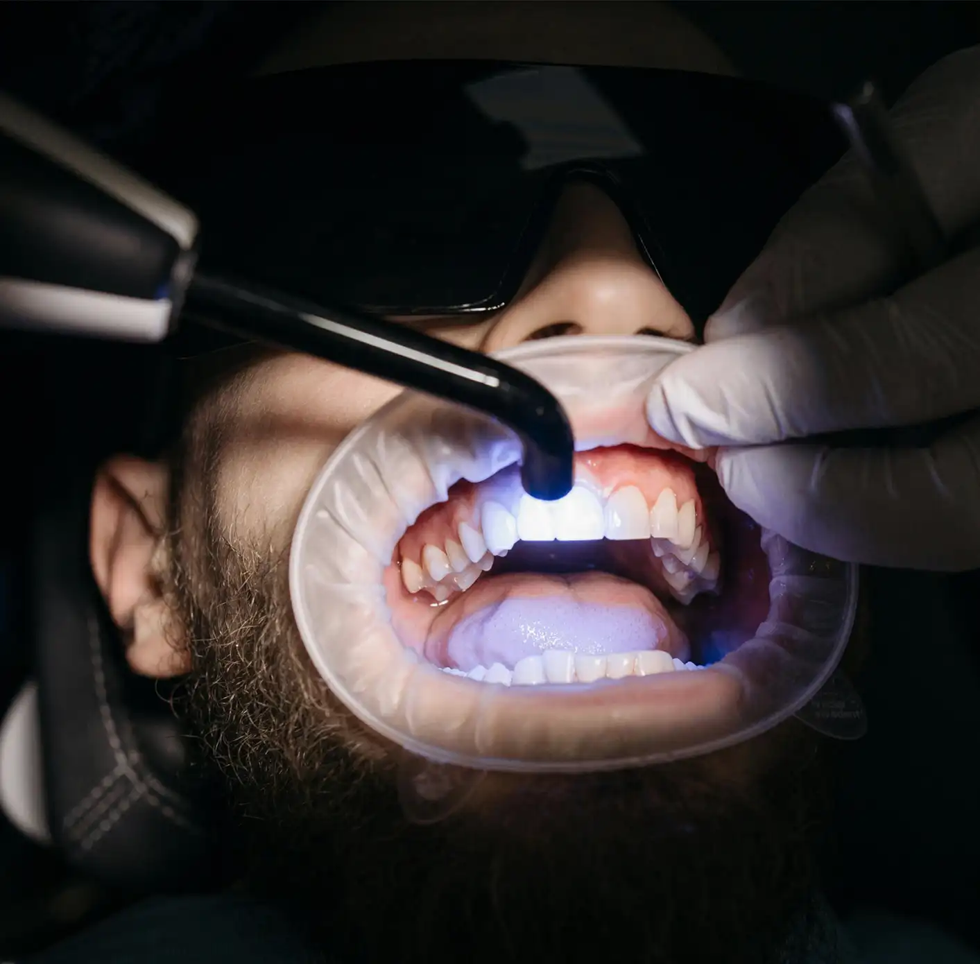 Close-up of a person receiving a teeth whitening treatment with a dental light device in an open mouth.