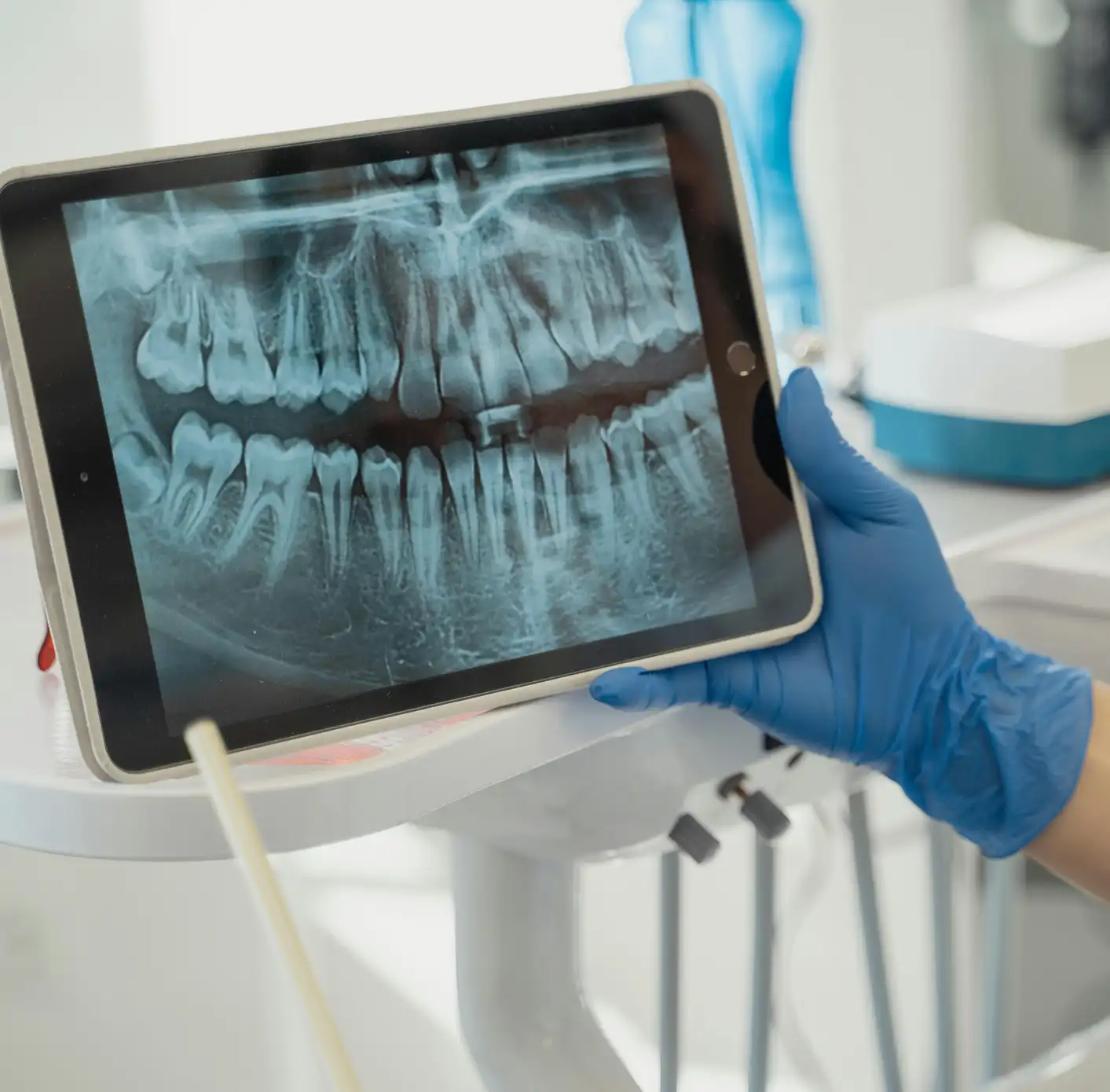 A hand wearing a blue glove holding a tablet displaying a dental X-ray image of upper and lower teeth examining need for dental crown.