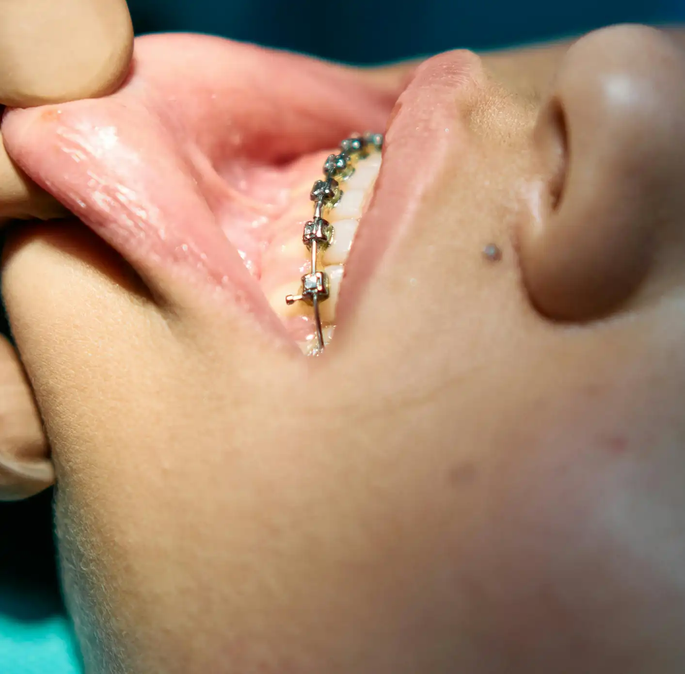 Close-up of a person's teeth with metal braces on the inside of the lower teeth, mouth held open.